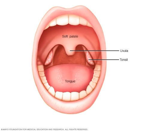 Lingual Tonsil Cancer Symptoms