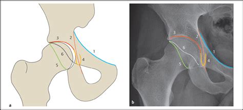 Hip(I) | Radiology Key