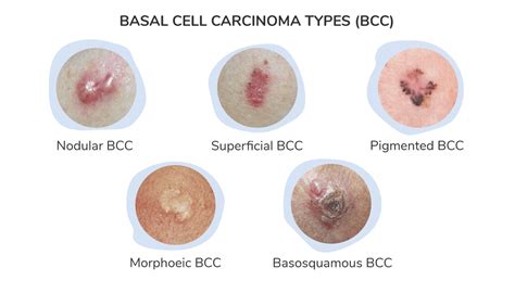 Skin Cancer - Basal Cell Carcinoma - Dyson Dermatology Tucson, AZ