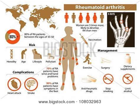 Rheumatoid Arthritis Vector & Photo (Free Trial) | Bigstock