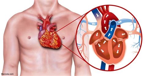 How is Heart Blockage Treated?