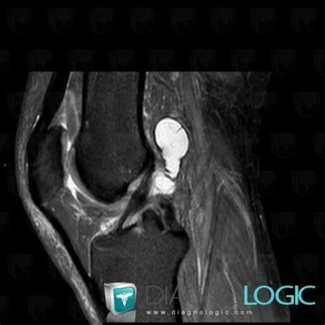 Radiology case : Synovial cyst (MRI) - Diagnologic