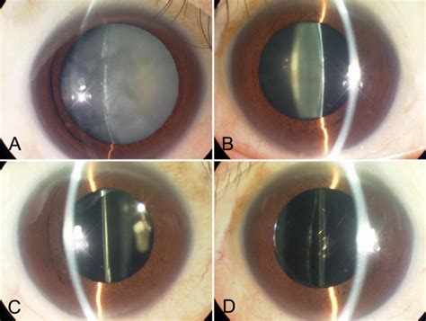 Slit lamp examination on initial before and after the surgery. Initial... | Download Scientific ...