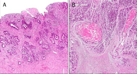 Histologic findings in common bile duct tissue removed at surgery... | Download Scientific Diagram