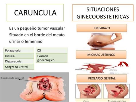 Resultado de imagen de caruncula uretral | Prolapso uterino, Miomas ...