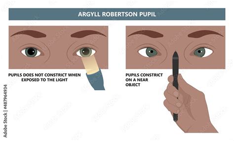 miosis eye pupil size iris retina brain Horner miotic muscle dilated ...