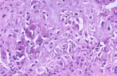 Chondroblastoma Workup: Imaging Studies, Tissue Diagnosis, Histologic Findings