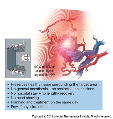 Arteriovenous Malformation AVM - SeattleNeurosciences.com