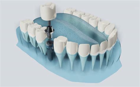 Dental Implants Risks to Consider Before Surgery - Westover Family Dental