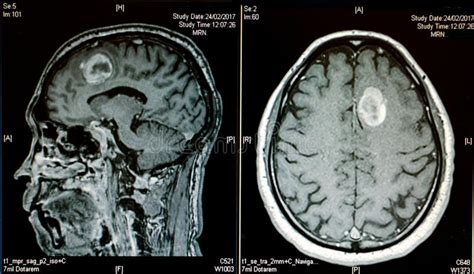 Hemorrhagic Stroke . CT Scan (computed Tomography) of Brain ( C Stock Photo - Image of internal ...