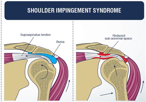 Shoulder Impingement Syndrome: Symptoms, Causes, Diagnosis & Treatment » How To Relief