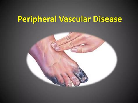 peripheral vascular disease | PPT