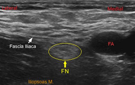 Fascia Iliaca block for femoral fractures