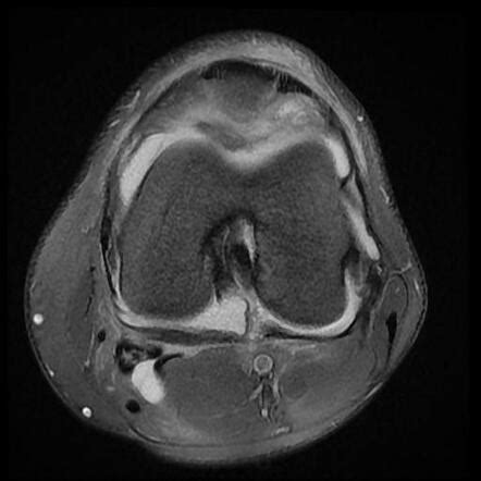 Patellar fracture (MRI) | Image | Radiopaedia.org