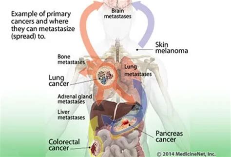 Understanding Cancer: Metastasis, Stages of Cancer, and More