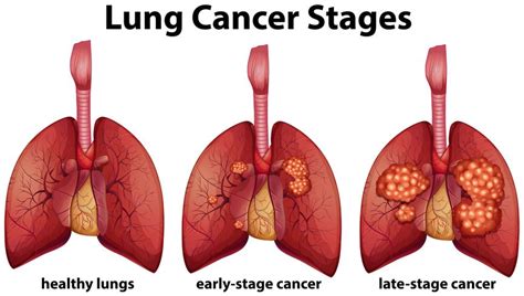 Diagram showing lung cancer stages 301312 Vector Art at Vecteezy