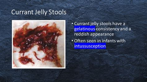 Intussusception Poop