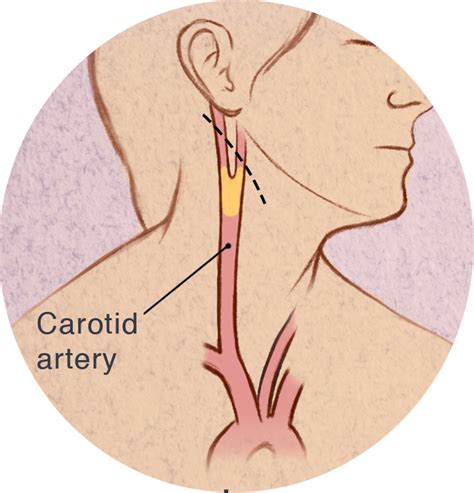 Carotid Endarterectomy Procedure for Patient Education – Mahon Illustrations