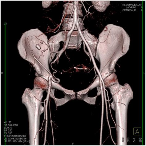 Iliac Artery