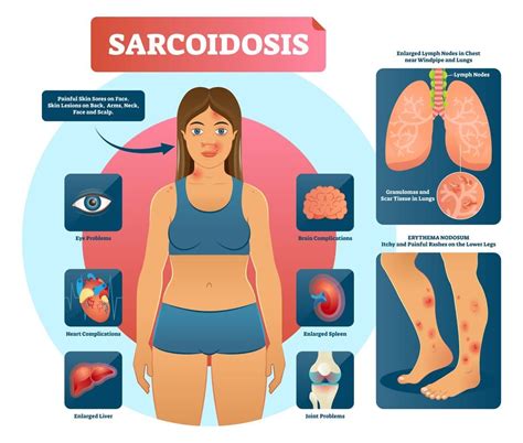 Sarcoidosis