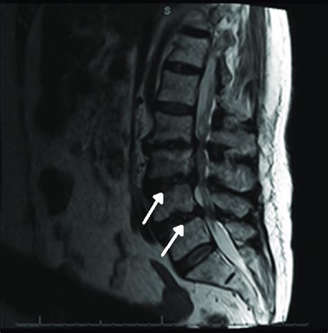 Lumbar Disc Disease Mri