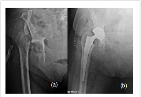 Final postoperative images: (a) After initial resection arthroplasty ...