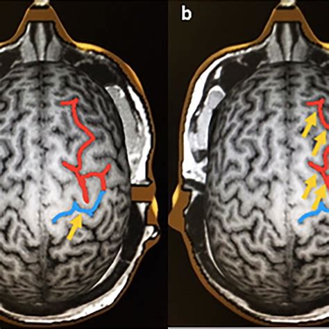 Location of the central sulcus with hand knob (blue) and precentral ...