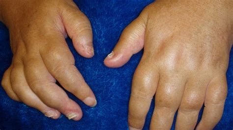 Pictures of Psoriatic Arthritis Symptoms