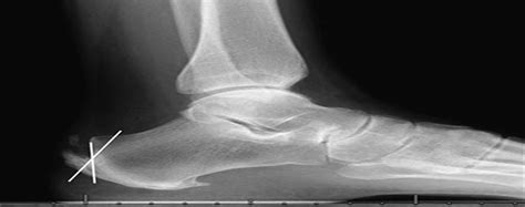 Calcaneus Exostectomy and Achilles Tendon Reattachment for t... : Techniques in Foot & Ankle Surgery