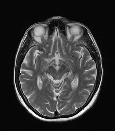 Progressive supranuclear palsy | Radiology Case | Radiopaedia.org