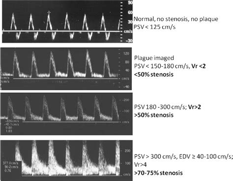 Figure 1 from Interpretation of arterial duplex testing of lower ...