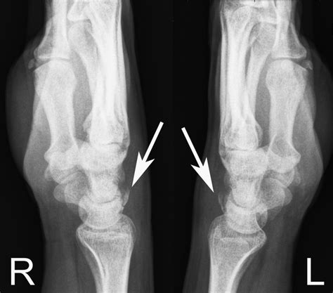 Triquetral Bone : Information and translations of triquetral bone in the most comprehensive ...