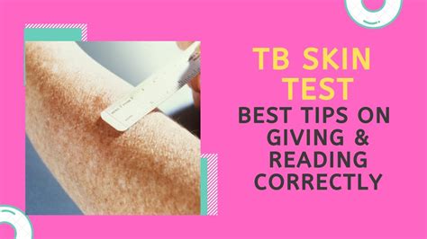 TB Skin Test: What Does it Mean When There isn't a Wheal After it is ...