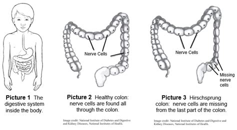 Hirschsprung's Disease Symptoms Causes Mayo Clinic, 44% OFF