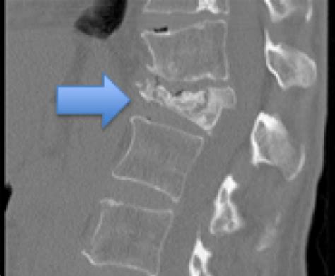 Vertebral Compression Fractures | Dr. Stieber in New York