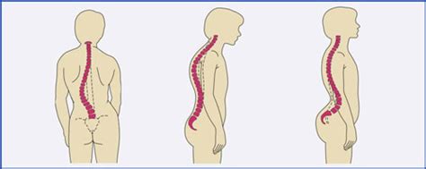 fix kyphosis, Dump the - 100circus.com