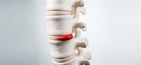 Disc Injury Relief Newport Beach | Treat Your Disc injuries!