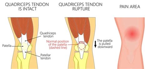 Ruptured quadriceps tendon causes, symptoms, diagnosis, treatment ...