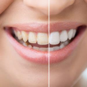 5 Reasons Why Your Teeth Are Changing Color | Dentist in Lansing, PA