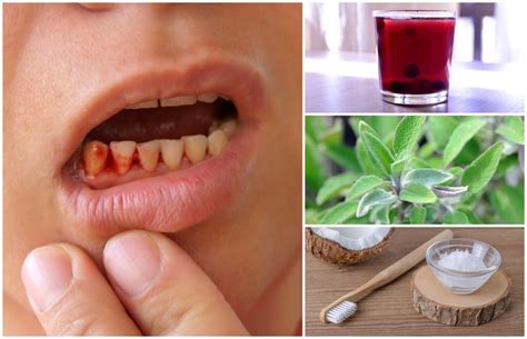 9 Best Home Remedies To Get Rid Of Gingivitis