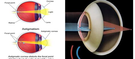 Astigmatism From Computer Screen : Alignment Challenges In The Context Of Astigmatism ...