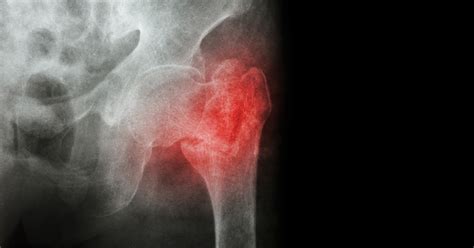 5 Common Hip Injuries - New Iberia, LA - Orthopedic Surgery - Wm. André ...