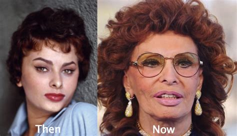 Sophia Loren Plastic Surgery Before and After Photos