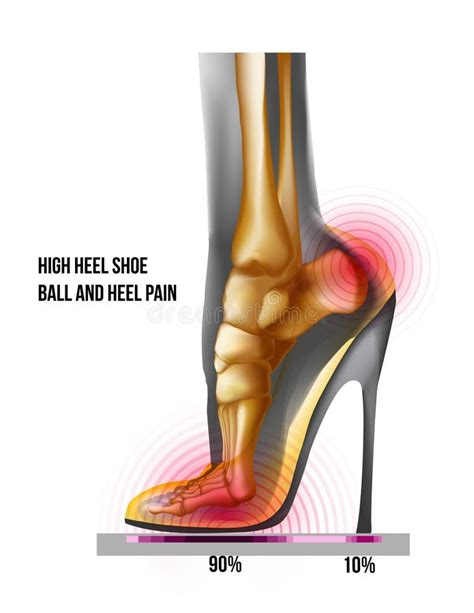 Ball of Foot Pain High Heel Shoe Bones Weight Distribution. X Ray Skeleton Realistic Anatomy ...