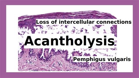 acantholysis - YouTube