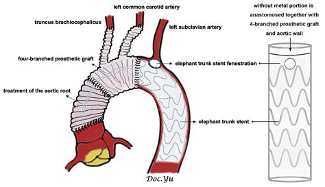 Elephant Trunk Stent Fenestration for Acute Type A Aortic Dissection ...