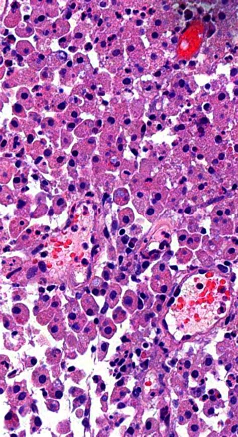 Pathology of Malakoplakia | Histology slides, Pathology, Blog