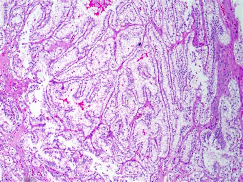 Renal Papillary Necrosis Histology