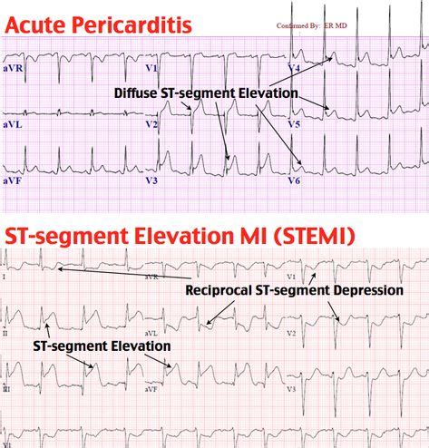 Acute Pericarditis vs. ST-Segment Elevation MI (STEMI) in 2020 (With images) | Cardiology ...