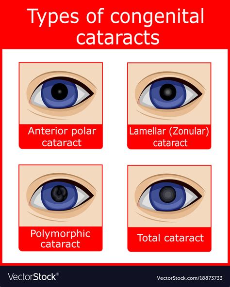 Types of congenital cataracts Royalty Free Vector Image